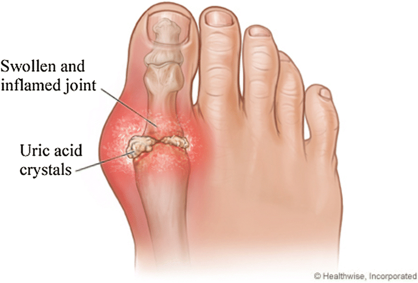 Gout Diagram